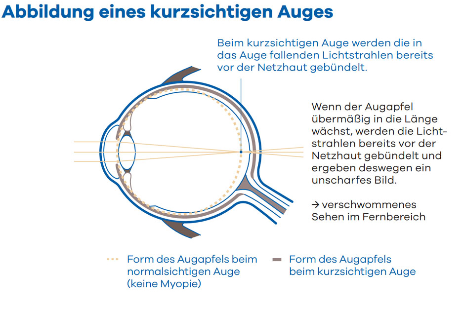 grehl_optic_miyosmart_kurzsichtiges_auge_abbildung_